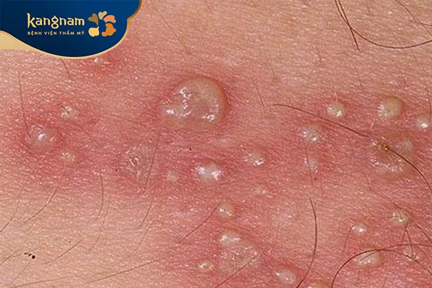 Sùi mào gà là một bệnh lây truyền qua đường tình dục do virus HPV gây ra