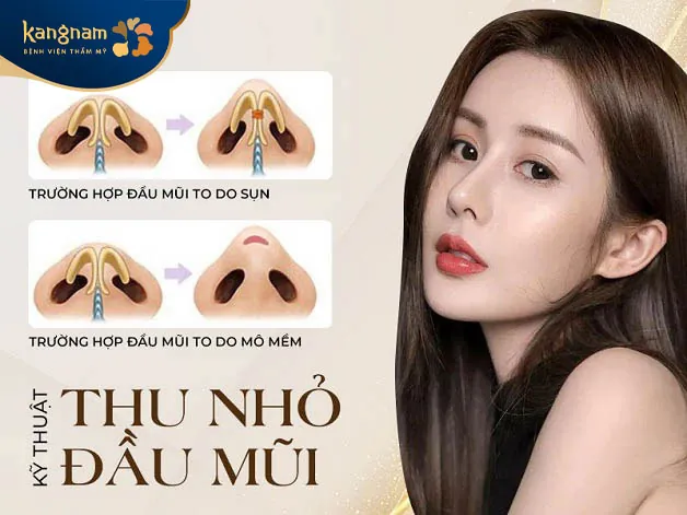 Kỹ thuật thu nhỏ đầu mũi giúp chiếc mũi thon gọn, cân đối