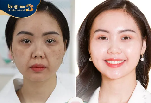 Meso giúp khắc phục tình trạng da chảy xệ, lão hóa