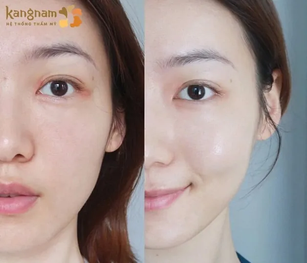 Làn da sáng, tươi trẻ hơn sau áp dụng liệu pháp meso