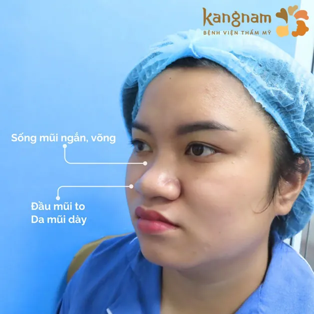 Đầu mũi to, da mũi dày nên cân nhắc thu gọn cánh mũi