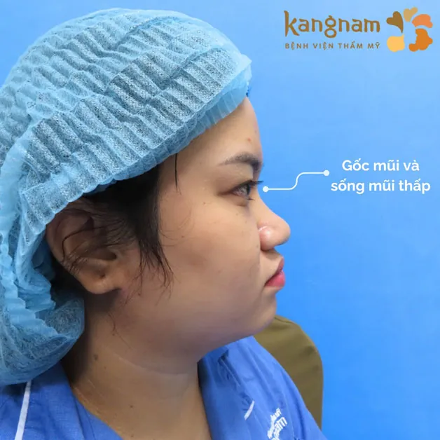 Mũi thấp tẹt, đầu mũi to có thể cân nhắc tạo hình mũi S Line