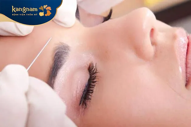 Treo cung mày bằng chỉ