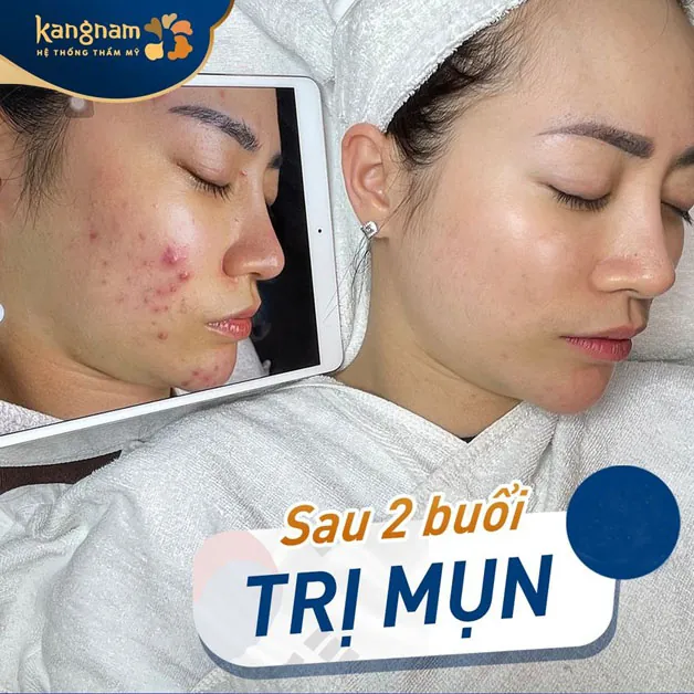 Kangnam cam kết hiệu quả điều trị mụn