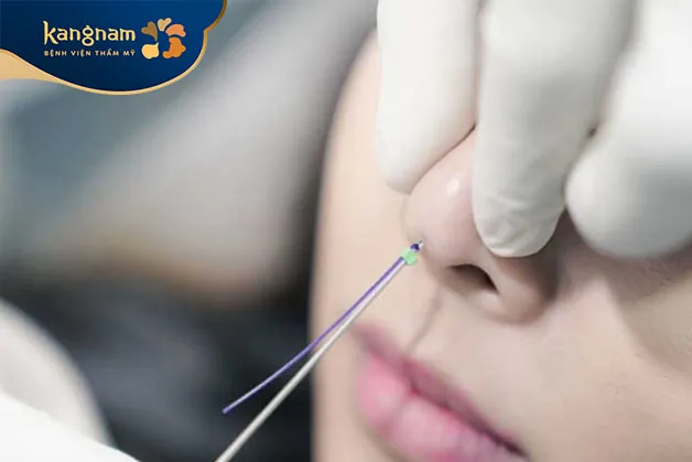 Quá trình căng chỉ mũi không đau đớn vì khách hàng sẽ được tiêm thuốc tê