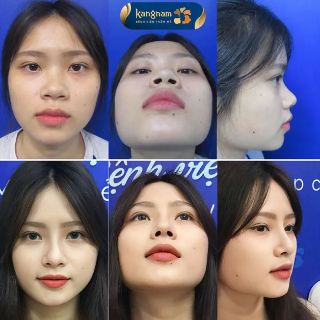 Nâng mũi Idol có thời gian ổn định rất nhanh