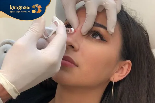 phương pháp tiêm filler mũi mang đến nhiều ưu điểm