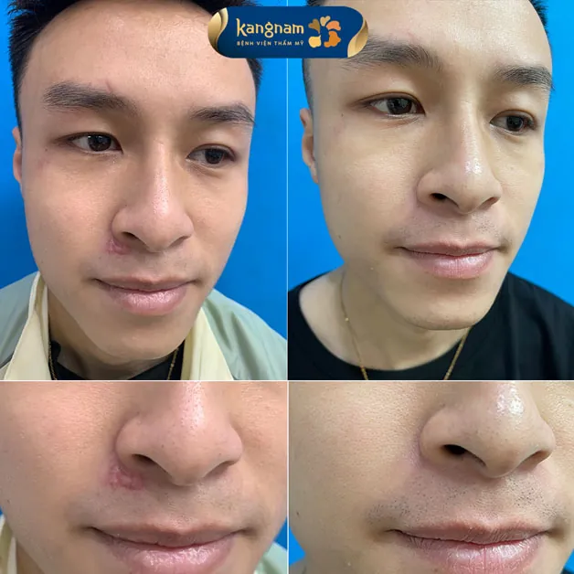 Xóa bỏ sẹo lồi sau 1 liệu trình