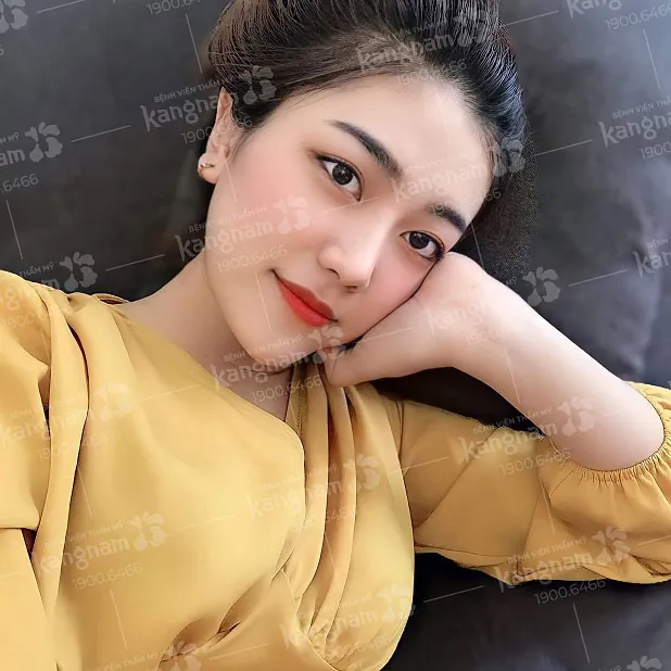 Khách hàng nâng mũi 3 năm vẫn tự nhiên, không biến chứng