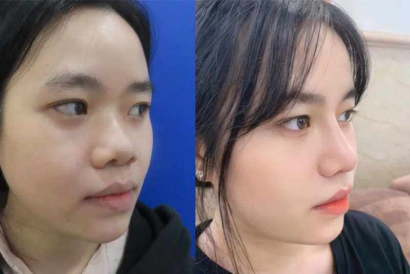 Khách hàng trước và sau khi nâng mũi cấu trúc