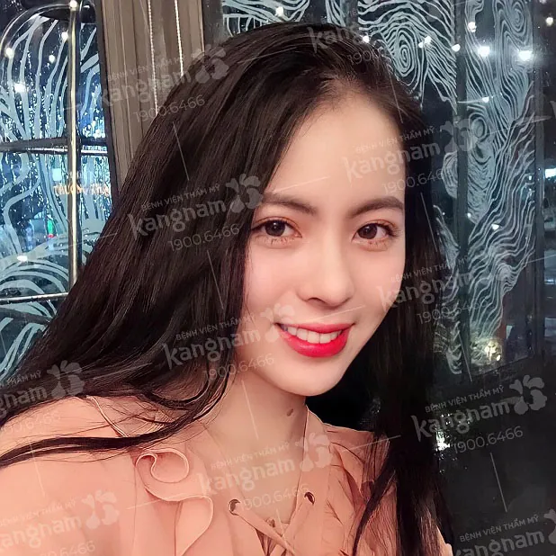 Feedback khách hàng nâng mũi 5 năm tại Kangnam, form mũi ổn định và đẹp