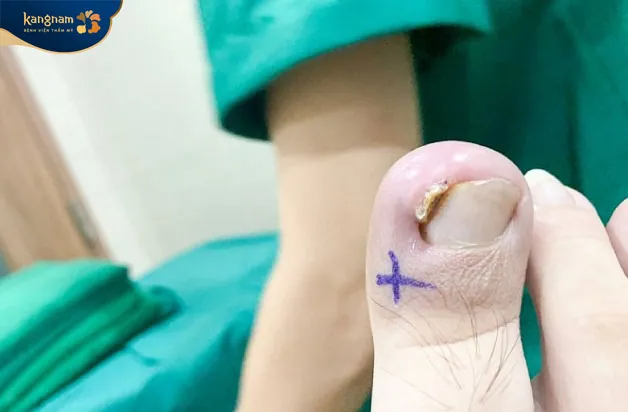 Nên đến cơ sở y tế để được điều trị