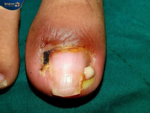 Khóe chân bị sưng mủ nặng cần phải can thiệp y tế