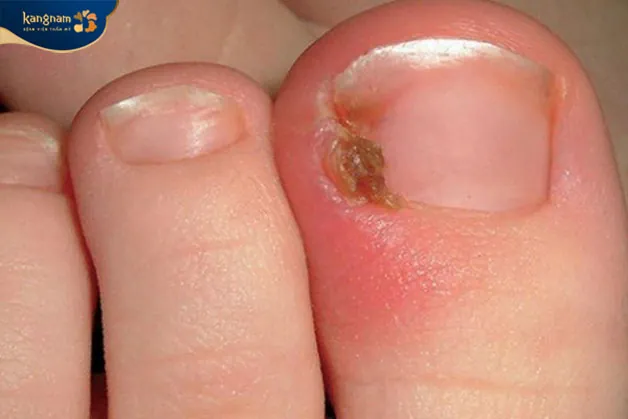 Khóe chân bị sưng tấy có mủ