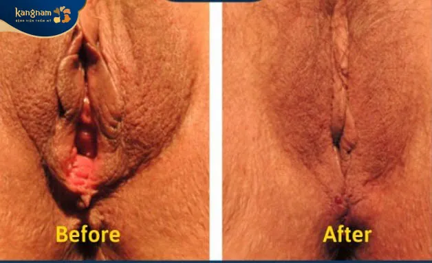Se khít và làm hồng không đau, không sẹo