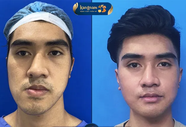 Sở hữu gương mặt điển trai sau khi chỉnh hàm lệch