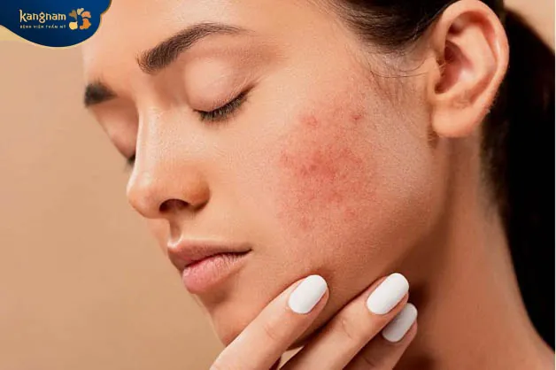 Hỗ trợ làm cân bằng nội tiết, giảm mụn trứng cá