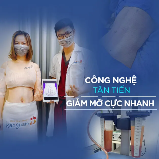 Kangnam là địa chỉ giảm mỡ an toàn, nhẹ nhàng và hiệu quả