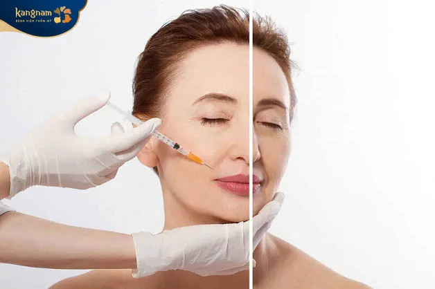 Filler Juvederm không gây đau vì đã được ủ tê