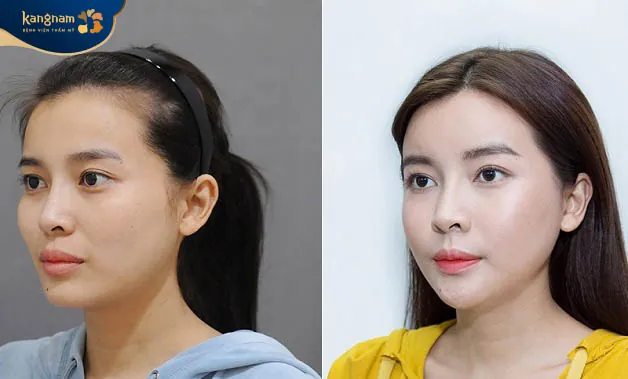 Bác sĩ tạo một đường mổ mảnh ở bên trong khoang miệng nên không để lại sẹo