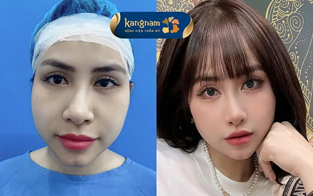 Khách hàng sau khi phẫu thuật gọt cằm tại Kangnam