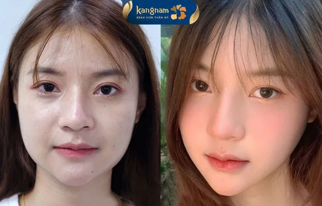 Gương mặt cân đối, nữ tính và hài hòa hơn