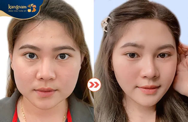 Tạm biệt gương mặt to bè, thiếu cân đối