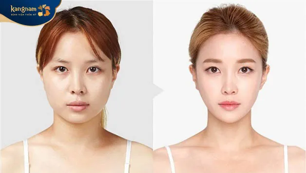 Gọt cằm giúp tạo gương mặt chuẩn tỉ lệ vàng