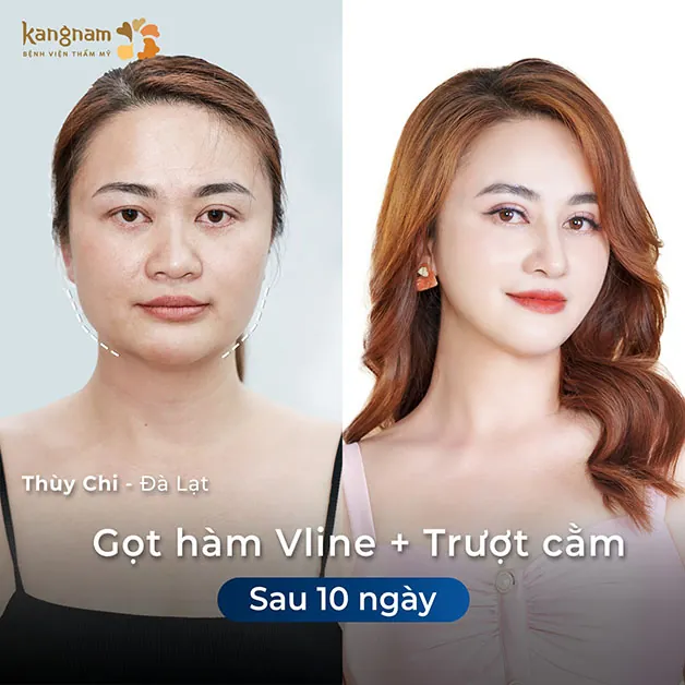 Thùy Chi trở nên xinh đẹp sau khi gọt hàm
