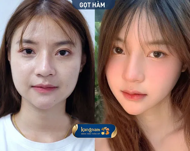 Tăng hạng nhan sắc chuẩn gái Hàn sau khi thu gọn cằm vuông
