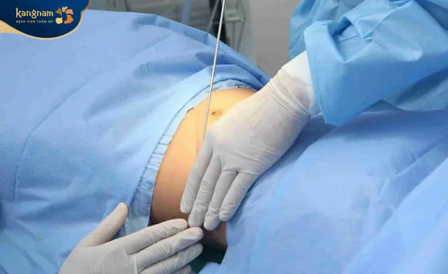 Hút mỡ bụng kiêng quan hệ bao lâu? Cần lưu ý điều gì