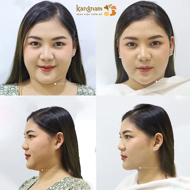 Cằm thon gọn, gương mặt nhỏ nhắn và thanh tú