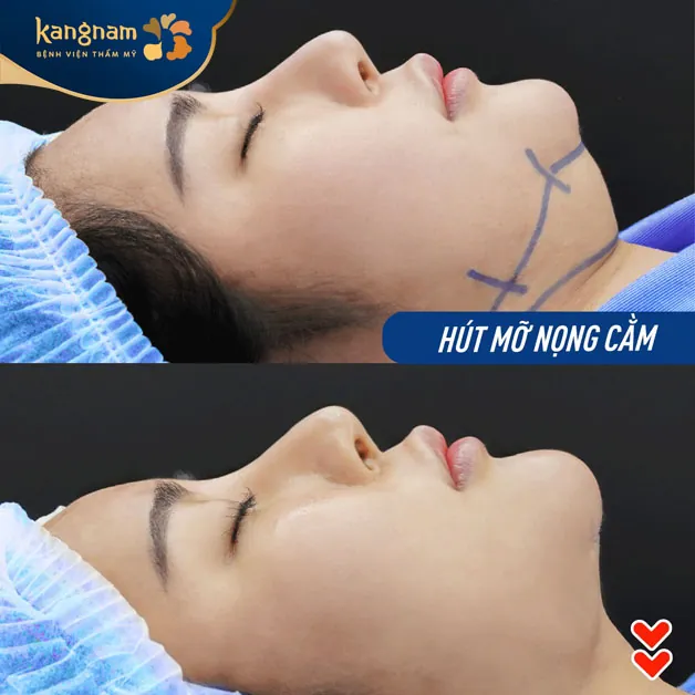 Loại bỏ mỡ nọng cằm giúp khách hàng sở hữu gương mặt thanh thoát