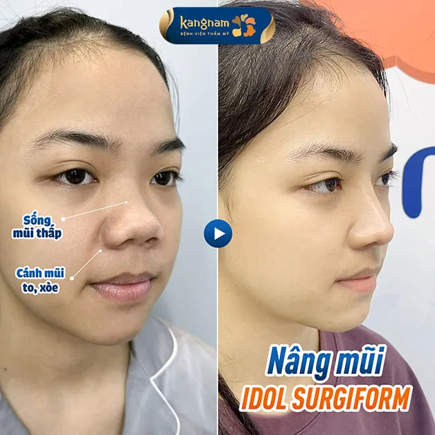 Cải thiện mũi hếch toàn diện sau khi nâng mũi cấu trúc Idol