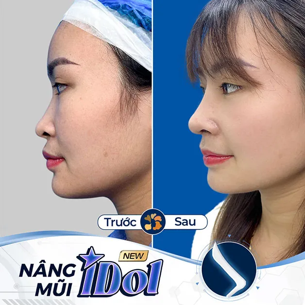 Kết quả nâng mũi lâu dài, chắc chắn