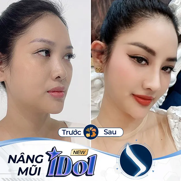 Hình ảnh sau khi nâng mũi, khắc phục toàn diện mũi thấp, đầu mũi ngắn