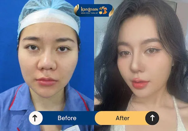 Mũi thon gọn và có điểm nhấn sau khi thu nhỏ cánh mũi