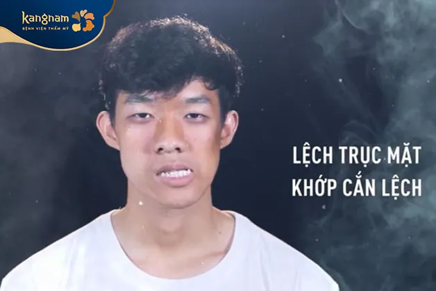 Minh Hoàng lệch mặt do tai nạn