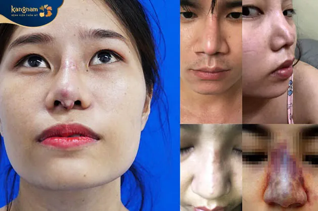 Triệu chứng bất thường sau nâng mũi