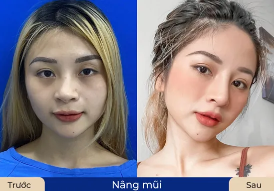 Kết quả sau khi khách hàng nâng mũi tại Kangnam