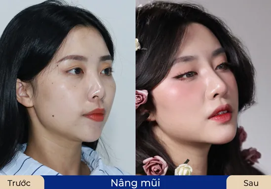 Form mũi cao và đẹp sau khi nâng