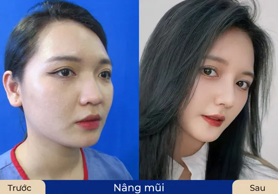 Sau khi nâng mũi tại Kangnam vết thương nhanh chóng phục hồi, vào form đẹp như ý