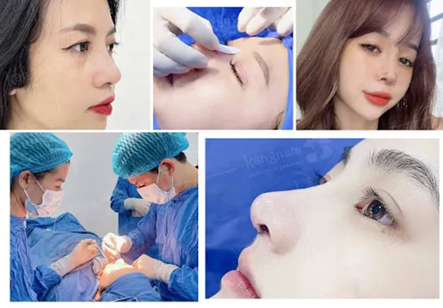 Lưu ý quan trọng trước và sau khi nâng mũi