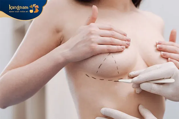 nâng ngực qua đường chân ngực có thể được coi là một lựa chọn tốt cho nhiều người