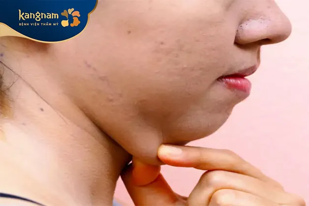 Một số người có xu hướng dễ bị tích mỡ ở cằm do di truyền