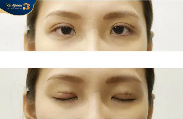 Chi phí nhấn mí ảnh hưởng bởi nhiều yếu tố