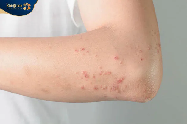 Các nốt mụn ngứa ở tây mọc đơn lẻ hoặc theo tùng cụm