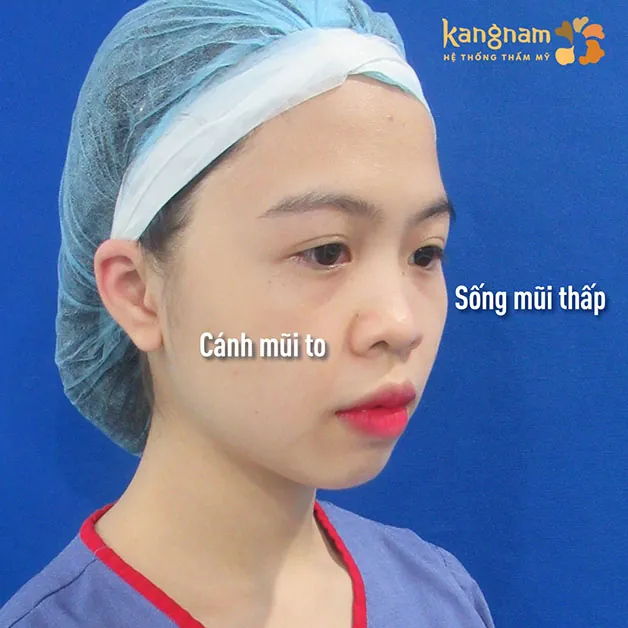 Dáng mũi thấp làm mất thẩm mỹ