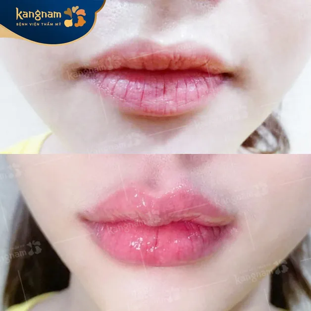 Khách hàng sở hữu đôi môi quyến rũ sau khi cắt môi tim