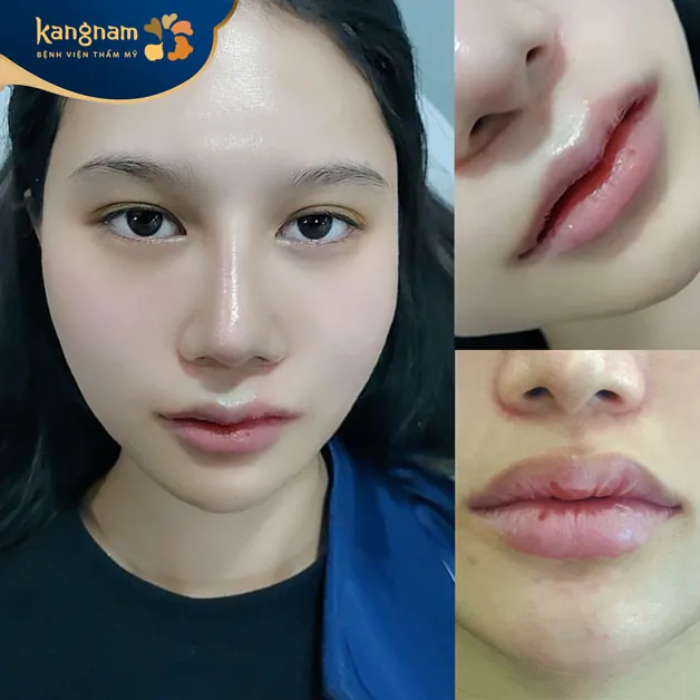 Gương mặt sắc sảo hơn sau khi sở hữu môi trái tim